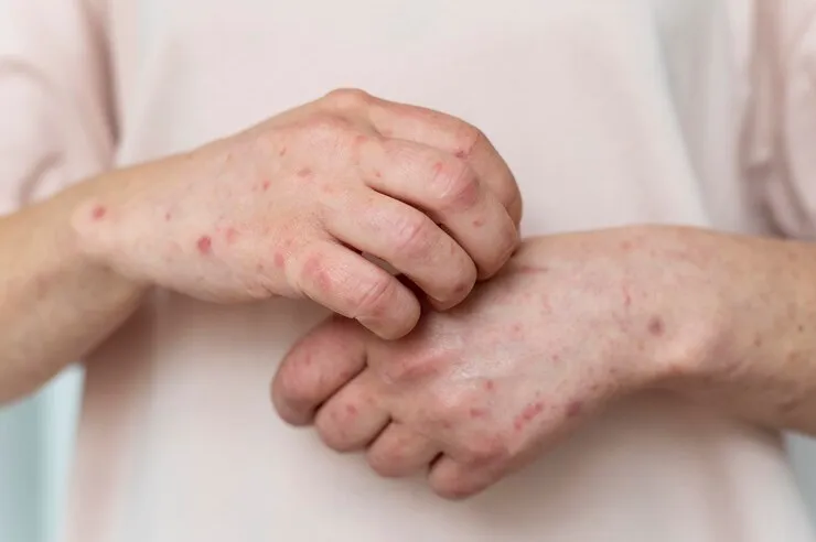 Psoriasis & Skin Diseases